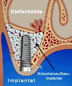 Sinuslift - Knochenaufbau des Oberkiefers